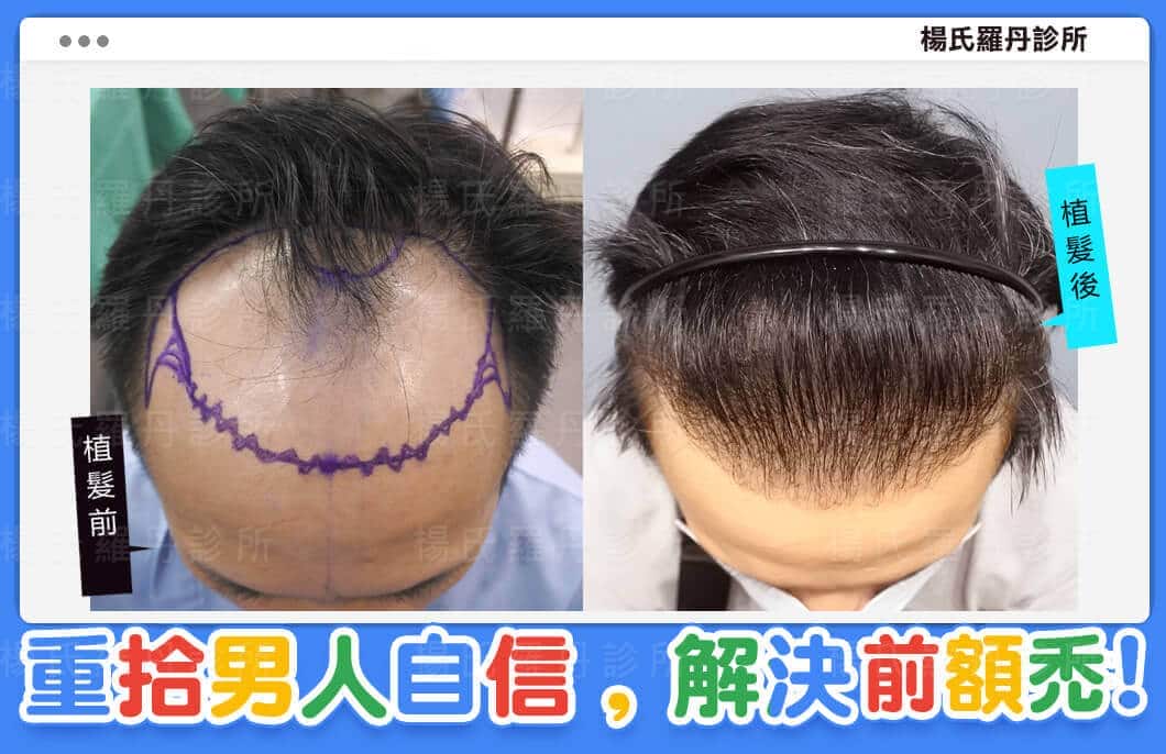 【植髮】重拾男人自信，ARTAS系統植髮解決前額禿!